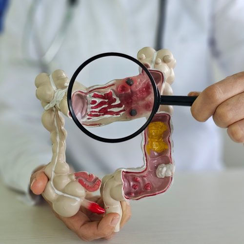 Magnifying,Glass,And,Colon,Diseases,And,Colorectal,Cancer,And,Ulcerative